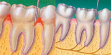 Dental Hygiene and Gum Disease