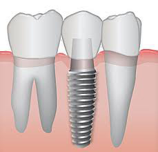 Dental Implant