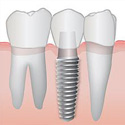 Dental Implants Thumbnail